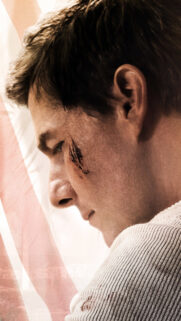 Sad Young Man with Facial Injury Mobile Wallpaper